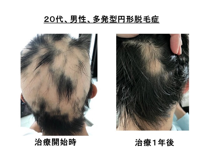 円形脱毛症　病院